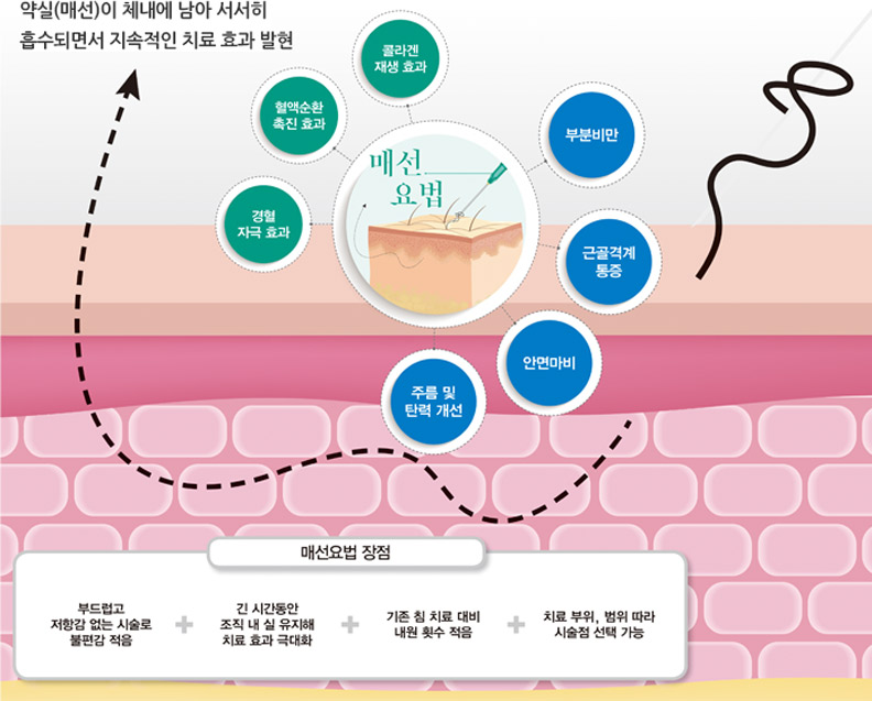 매선요법의 장점 : 1.부드럽고 저항감 없는 시술로 불편감 적응 2.긴 시간동안 조직 내 실 유지해 치료 효과 극대화 3.기존 침 치료 대비 내원 횟수 적응 4.치료 부위, 범위 따라 시술점 선택 가능